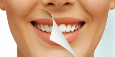 أنواع تبييض الأسنان بالليزر