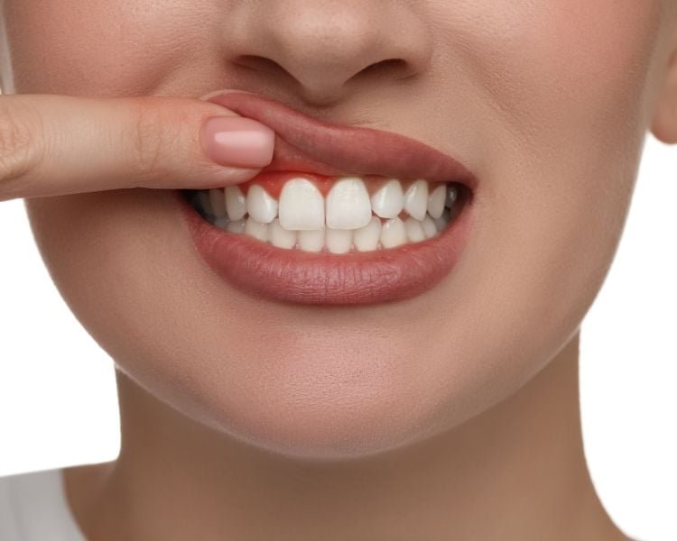انواع التهابات اللثة