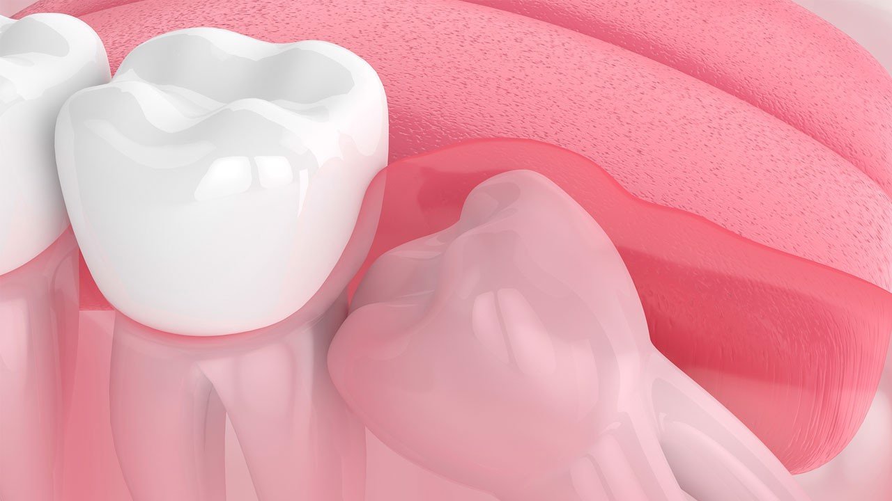 أعراض ضرس العقل المدفون