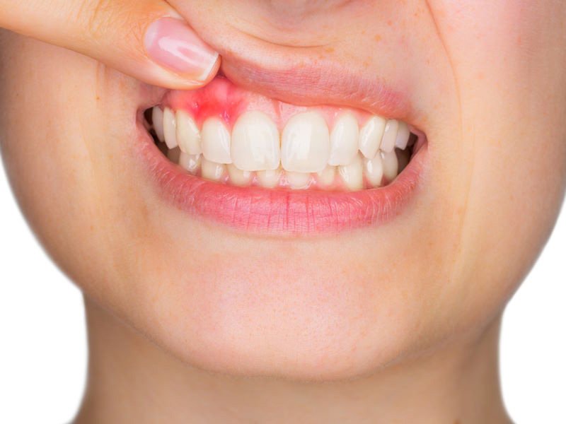 علاج خراج الأسنان للأطفال