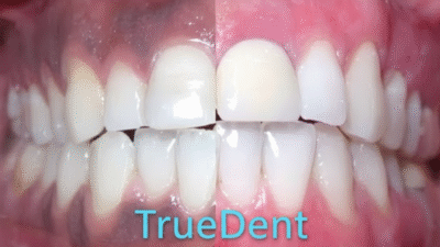 علاج اللثة الزرقاء في مركز TrueDent بتقنيات حديثة ومضمونة